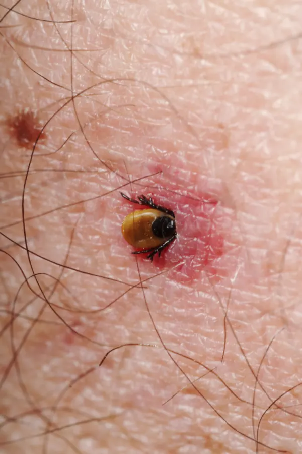 tick bite on a human